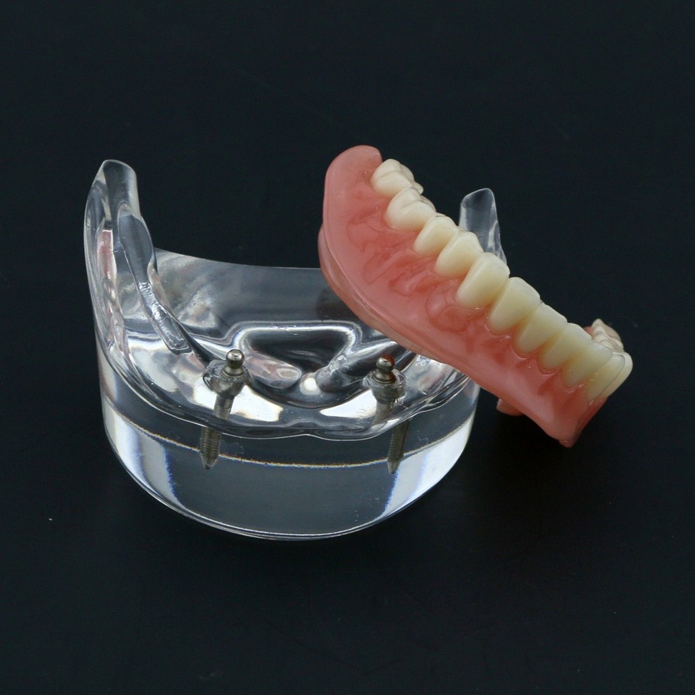 Dental Oral Transparent Upper Teeth 2/4 Implants Model Overdenture Restoration