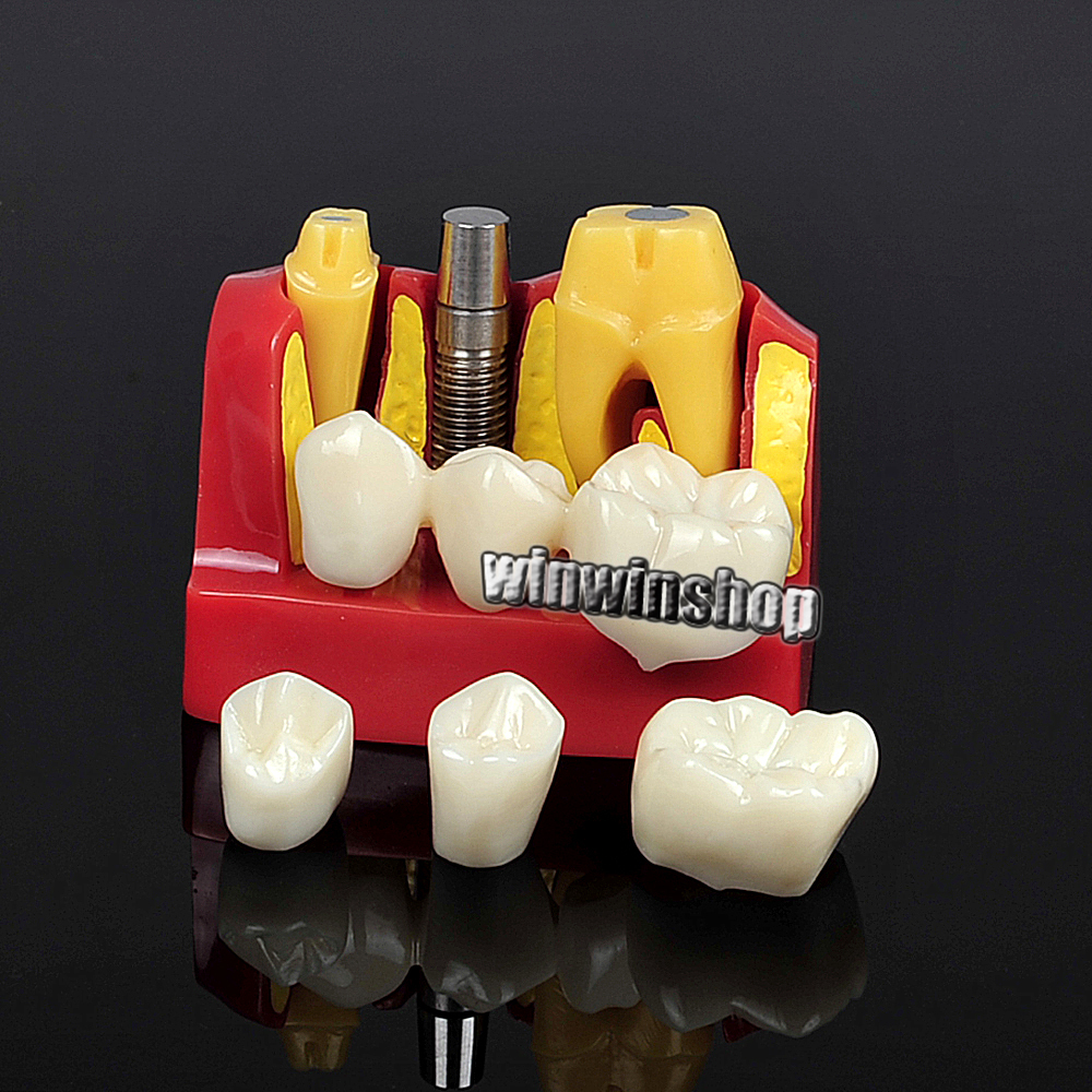 Dental Implant Analysis Crown Bridge Demonstration Teeth Model Remove Teach Lab