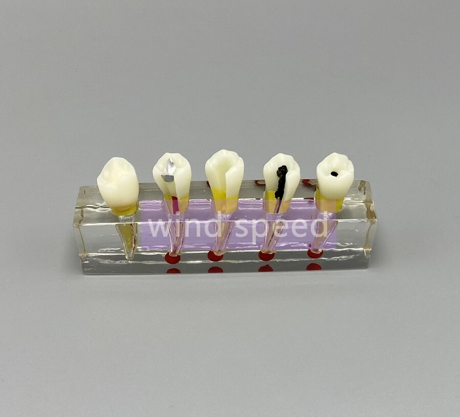 Dental Study Model Pulp Disease root canal curing Clinical Demonstration Analysi