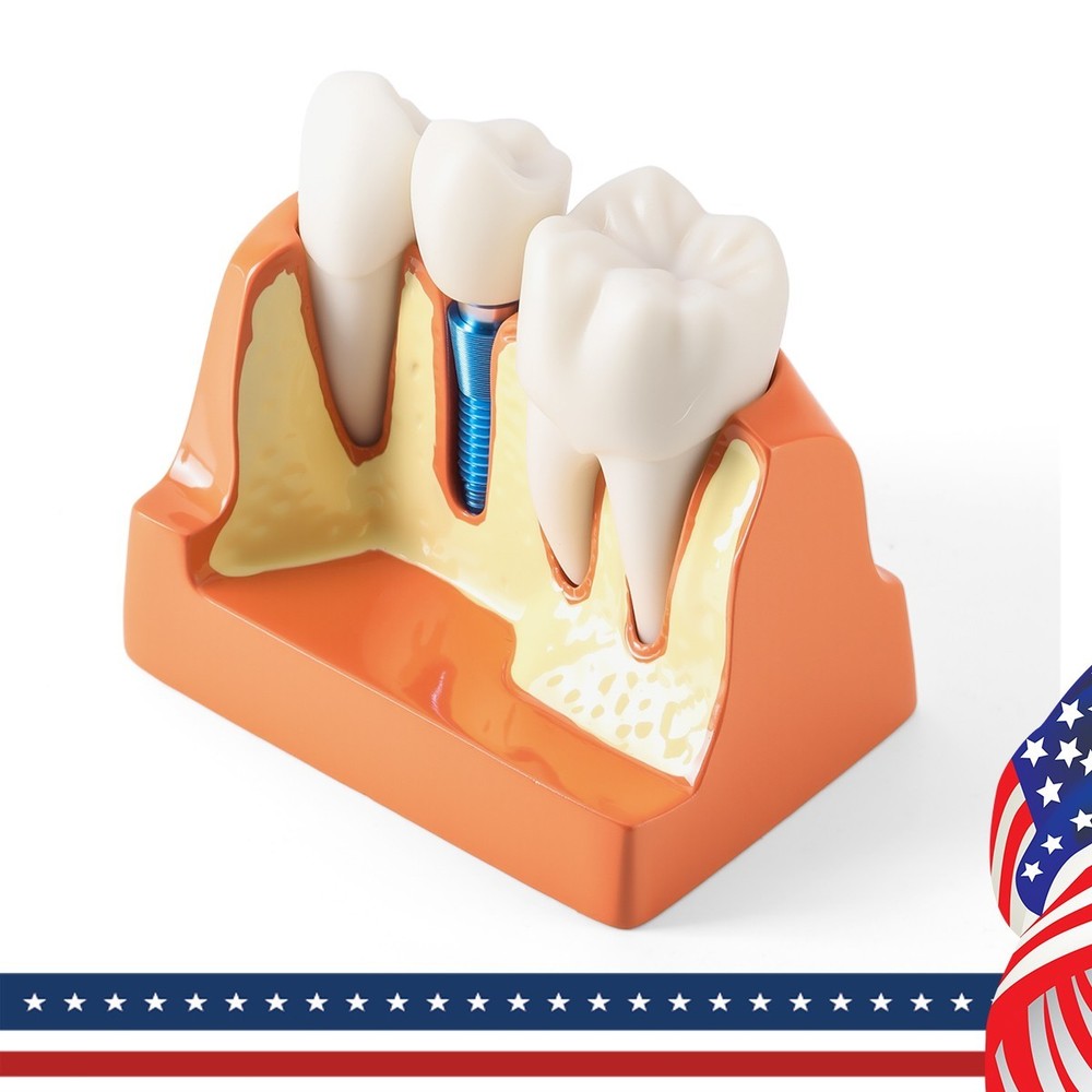 4 Times Dental Teeth Model Implant Crown Bridge Removable Study Teaching Tool