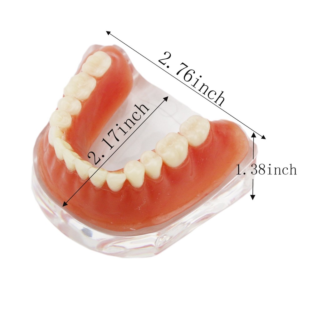 Detal Typondont Implant Teeth Model 4 Implants With Silver Golden Bar
