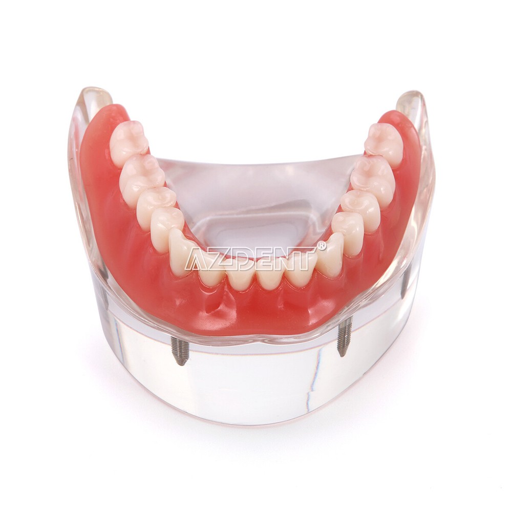 Dental Implant Teach Study Model Demo Overdenture Typodont 4Implants Upper Lower