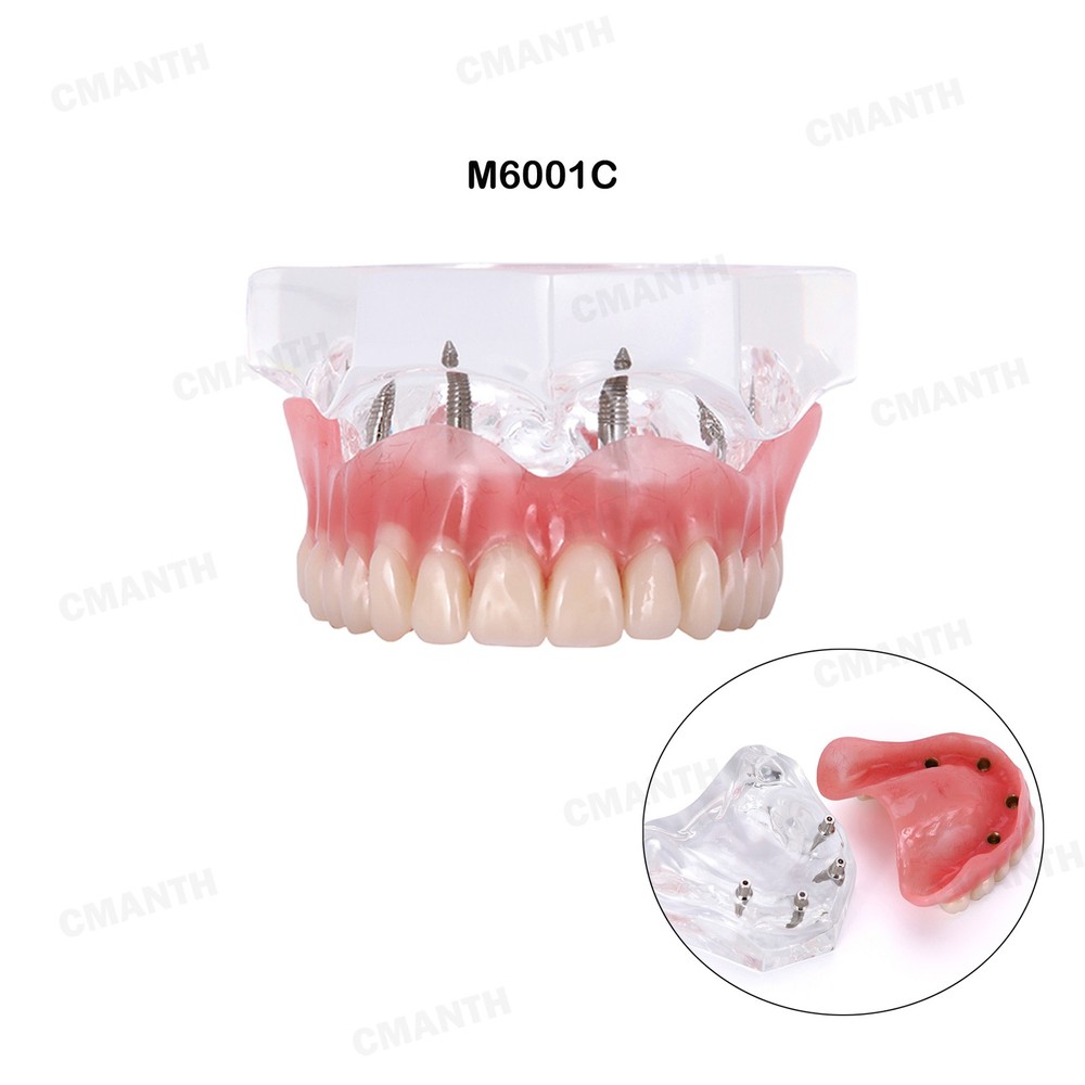 US Dental Model Removable Overdenture Teeth Upper/Lower Jaw 4 Implants Model