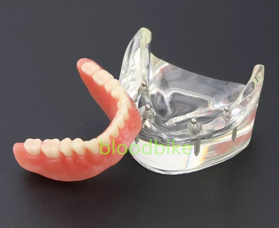1pc Dental Typodont Teeth Study Teach Model Implant Endo Caries Demonstration