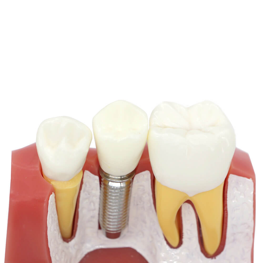 Dental Implant Demo Model with Removable Crown & Bridge for Analysis & Teaching