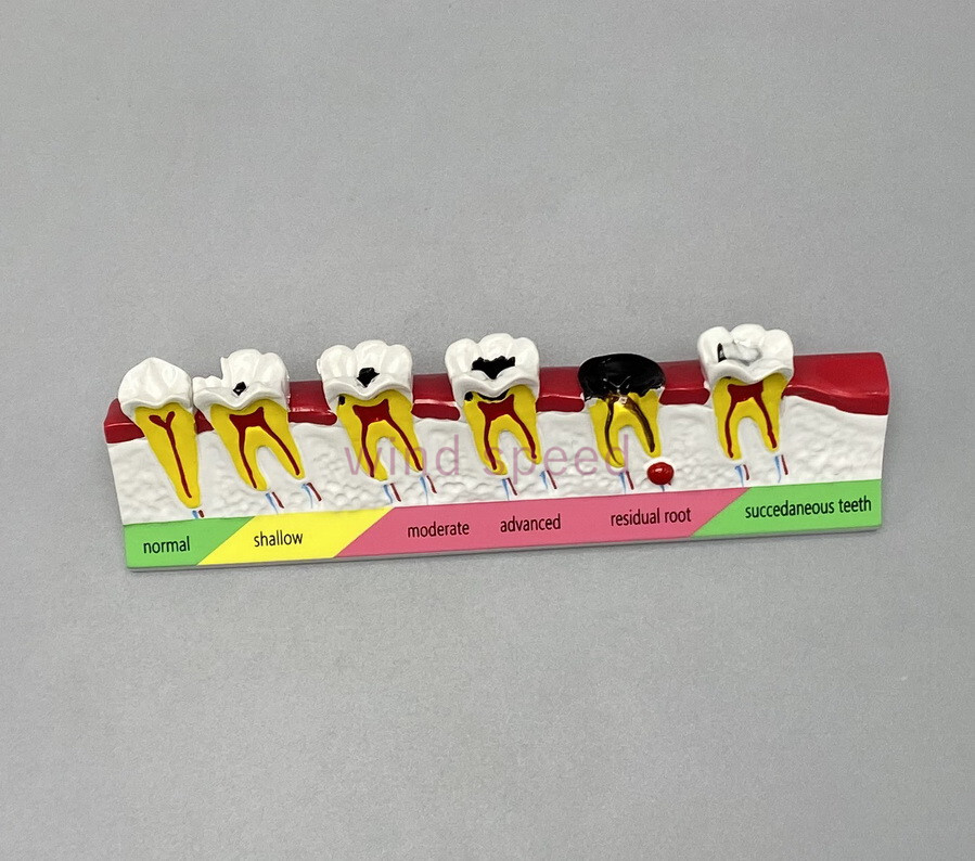 Dental Typodont Teeth Study Teach Model Implant Endo Caries Demonstration