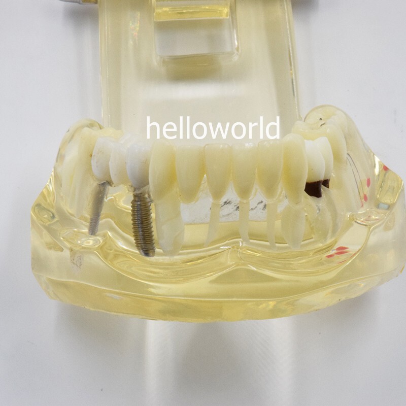 Dental Teeth Model Teach Study Oral Implant Restoration & Pathology Bridge