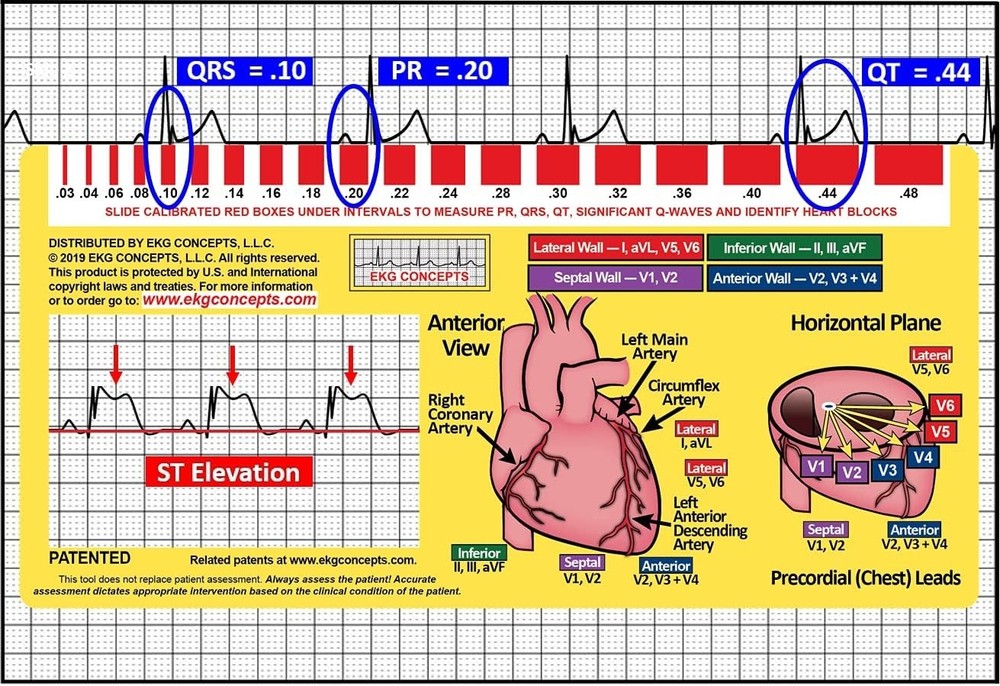 EKG Window 2nd Edition