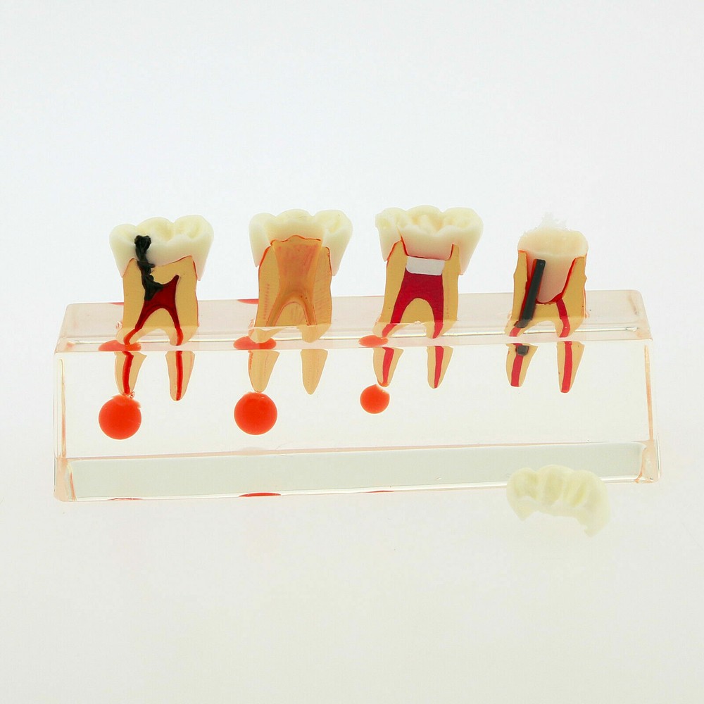 1 Pc Dental Study Typodont Teeth Model #4018 4 Stage Endodontic Treatment Model
