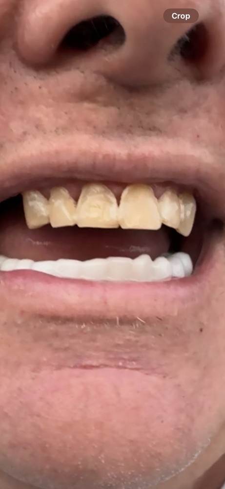 Custom Upper or Lower Cosmetic Click on Veneer