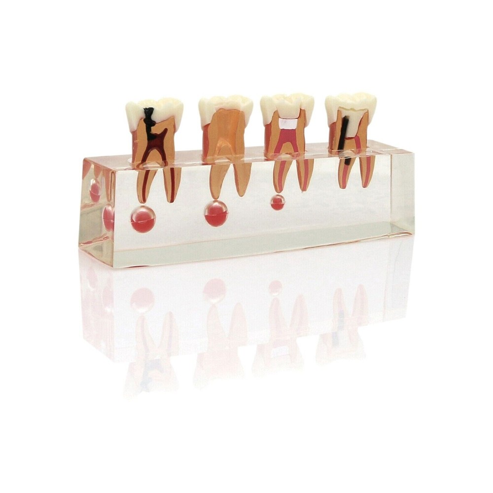 Dental Clear Pathological Typodont Teeth Model M4018 Molar Endodontic Treatment