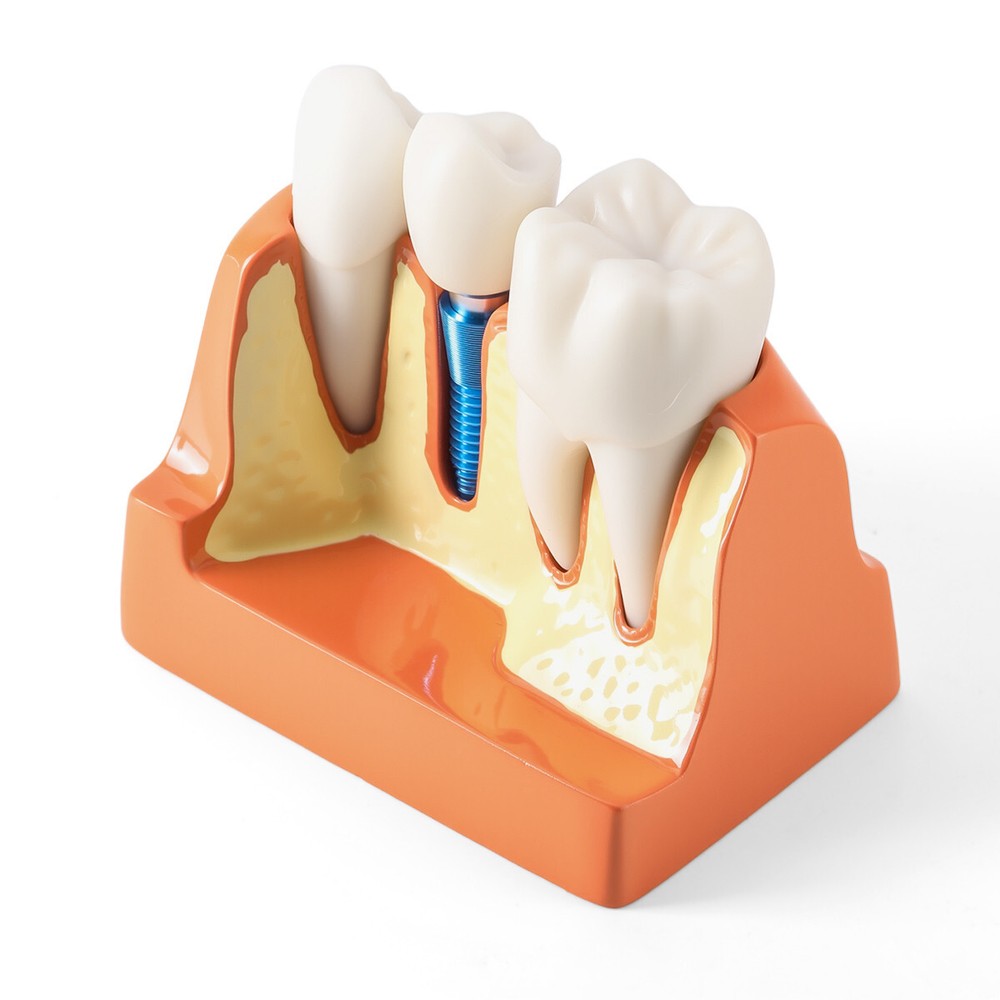 Dental 4Times Teeth Model Implant Analysis Crown Bridge Removable Study Training
