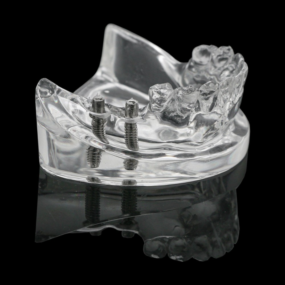 Dental Training Typodont Model with Removable Partial Denture Teaching Model