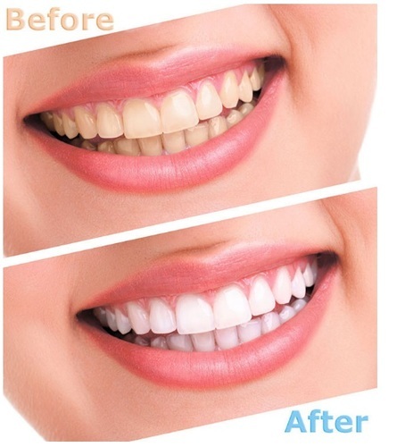Advanced Teeth Whitening Strips (2 Strips) 1 Upper and 1 Lower~Hydrogen Peroxide