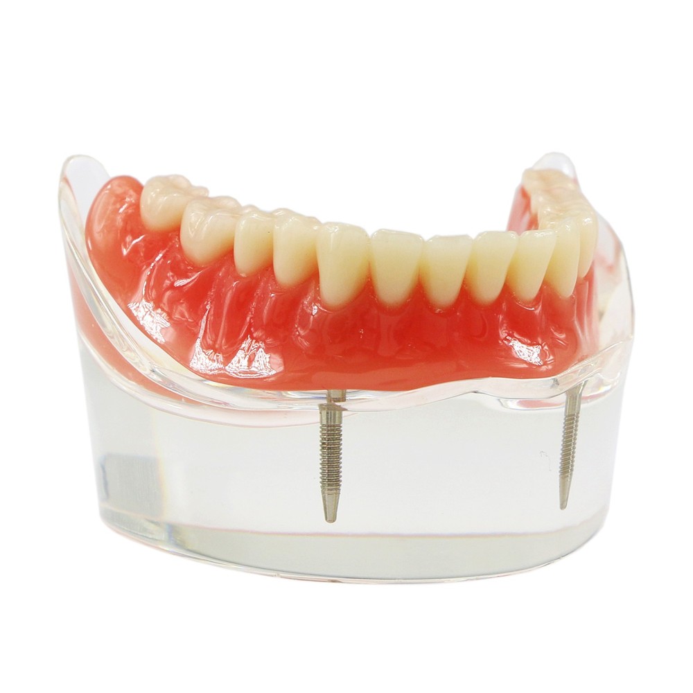 Implant Restoration Teeth Model Mandibular Overdenture with 2 Implants Dental