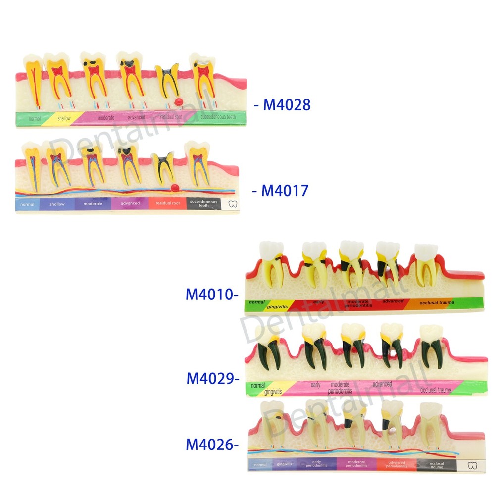 Dental Typodont Teeth Model Overdenture Implant Practice Endo Ortho Teachi Study