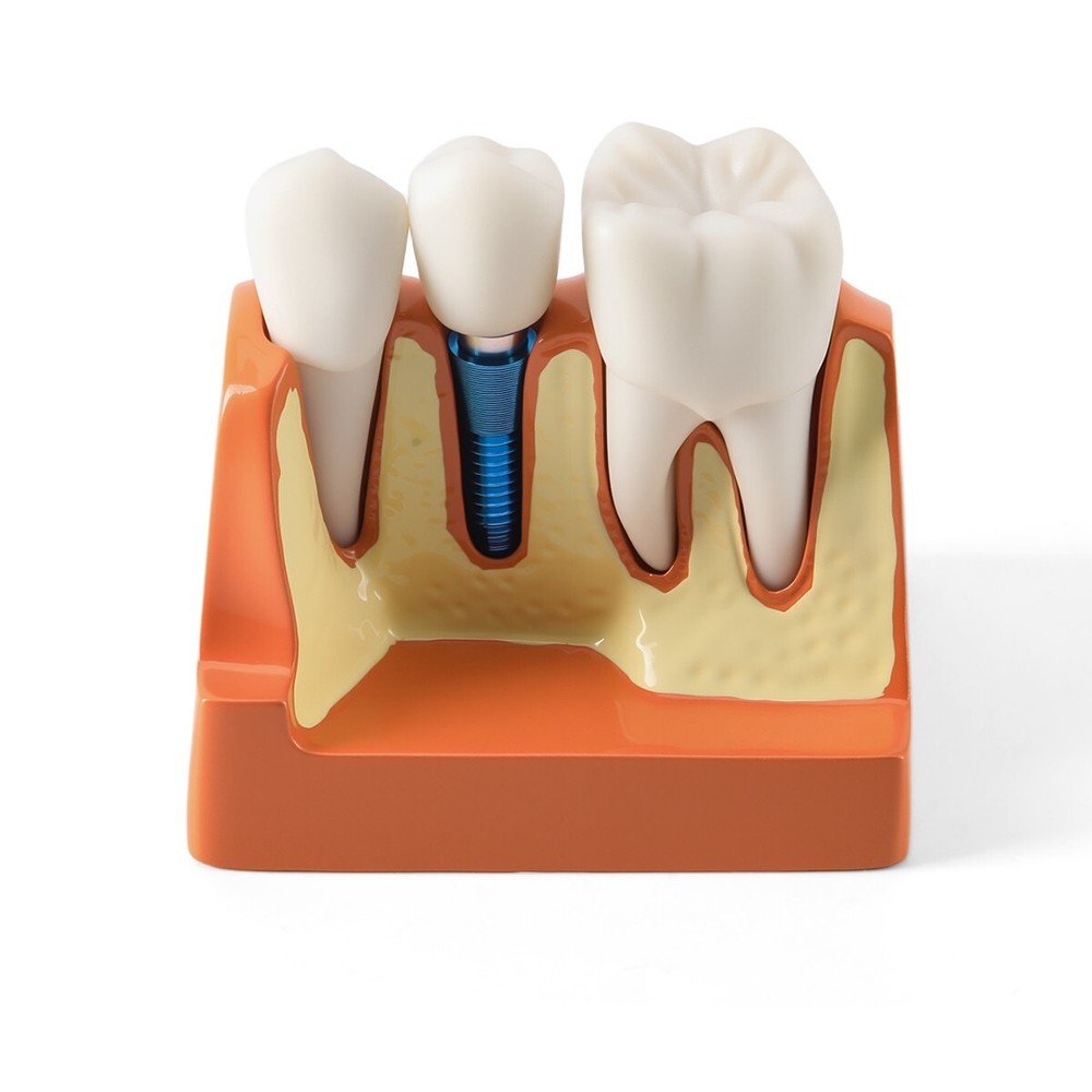 4 Times Dental Analysis Crown Bridge Demonstration Removable Teaching Model