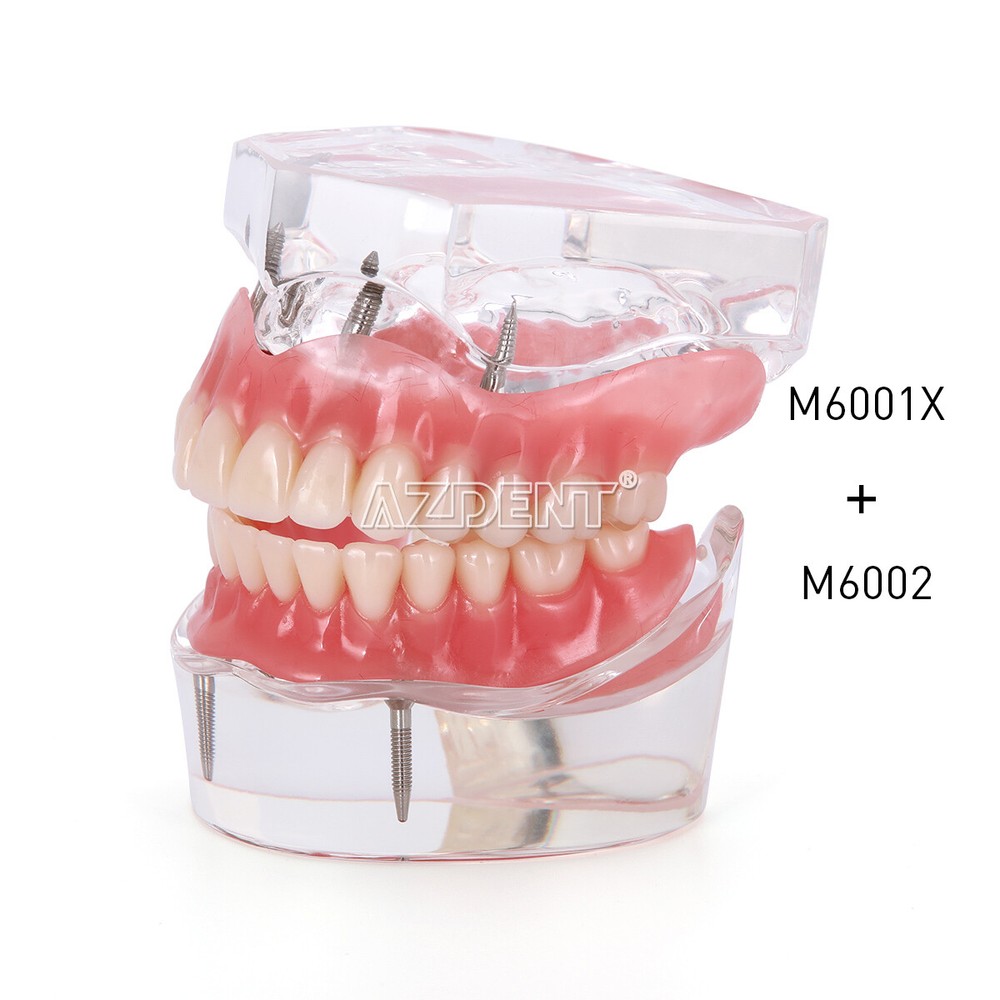 Dental Implant Teeth Model Demo Overdenture Restoration 2 / 4 Implants Upper Low