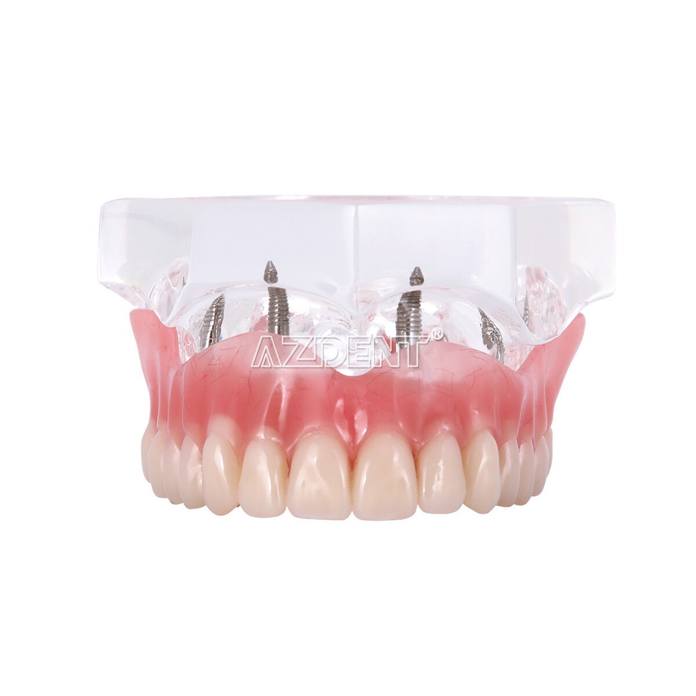 Dental Overdenture implant teeth model Denture with implant Demonstration Model