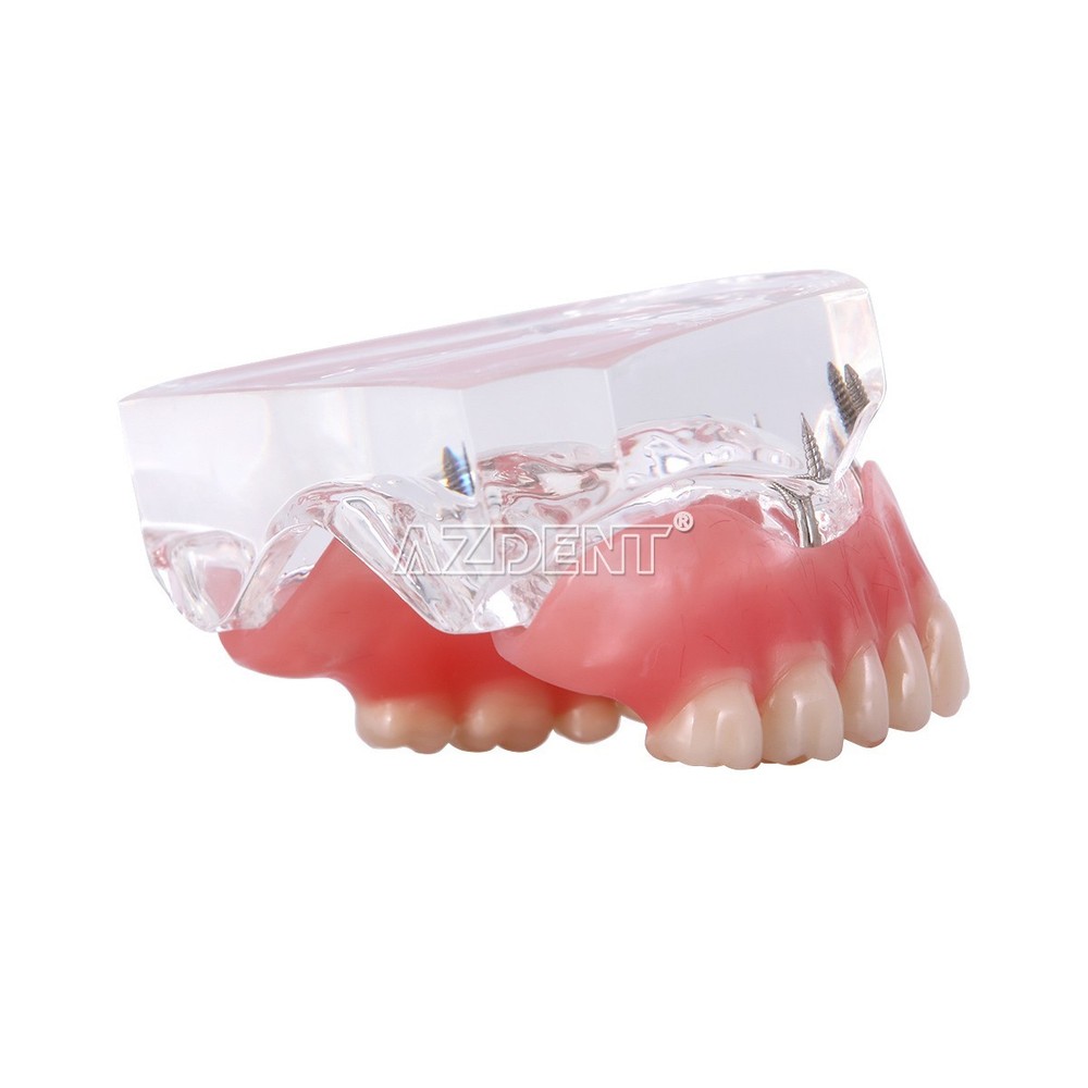 Dental Implant Teeth Model Demo Overdenture Restoration With Implants upper