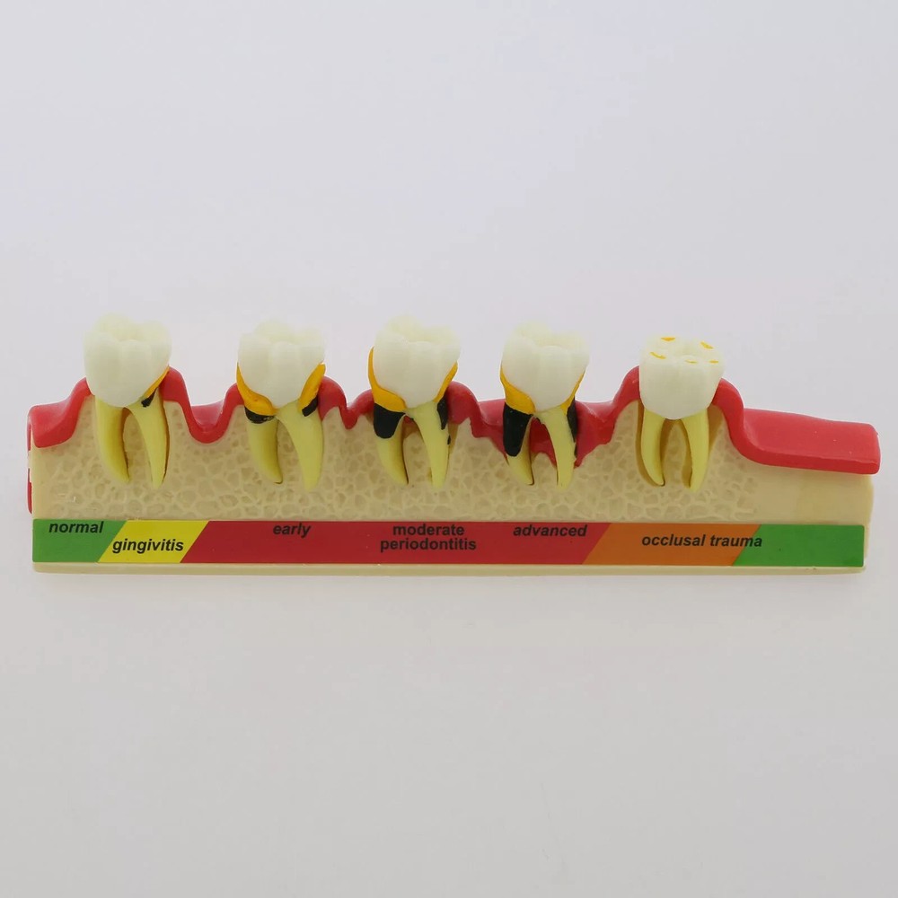 Dental Study Teaching Model Periodontal Disease 5-Stage Teeth Dentoform Typodont