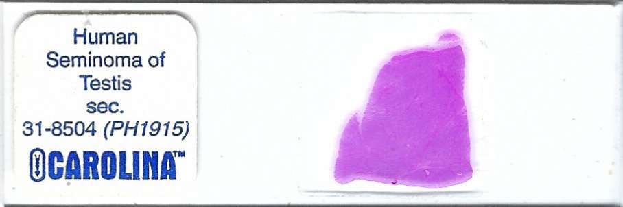 Human Seminoma of Testis Pathology Microscope Slide