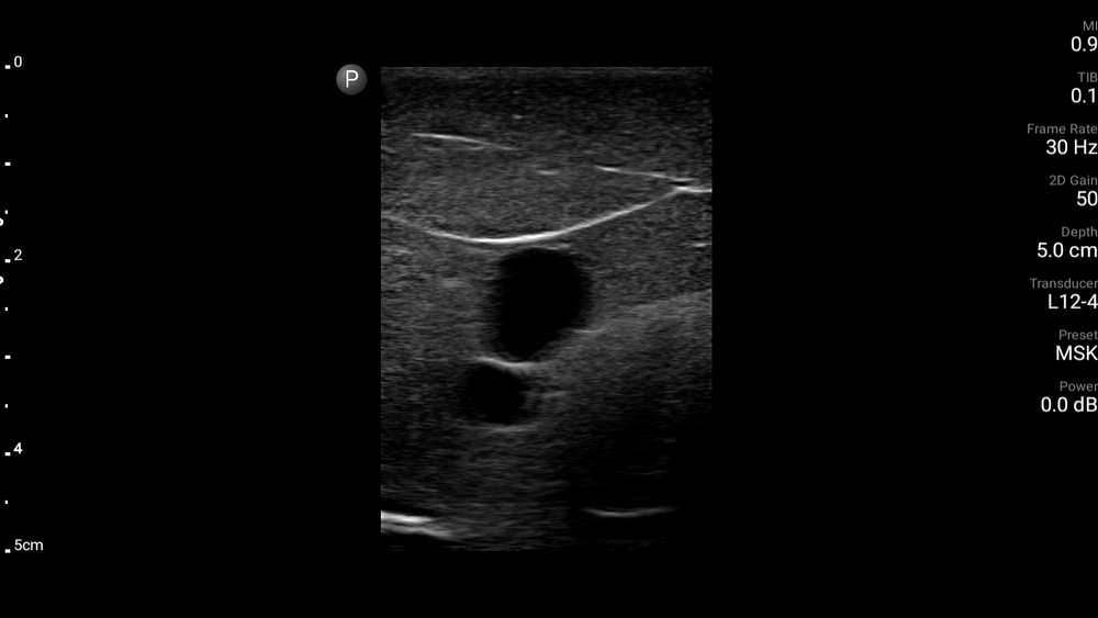Internal Juglar ultrasound phantom -CVC (FLUID FREE)