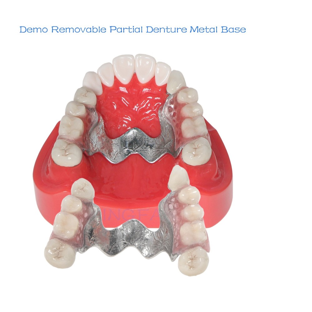 Dental Typodont Removable Partial Denture Model ,PRD Telescopic Crown Denture