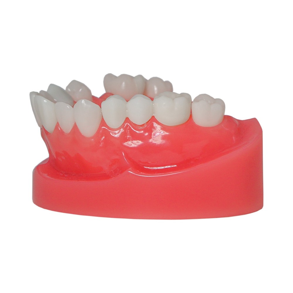 Dental Implant Disease Teeth Model Overdenture Implants Upper/Lower Demo