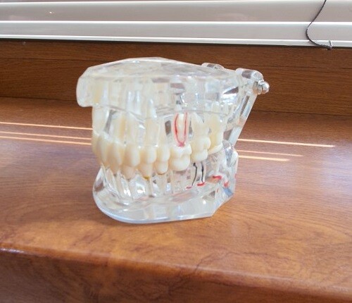 Dental Implant Teeth Model Disease Study Teaching Restoration Bridge Tooth Analy