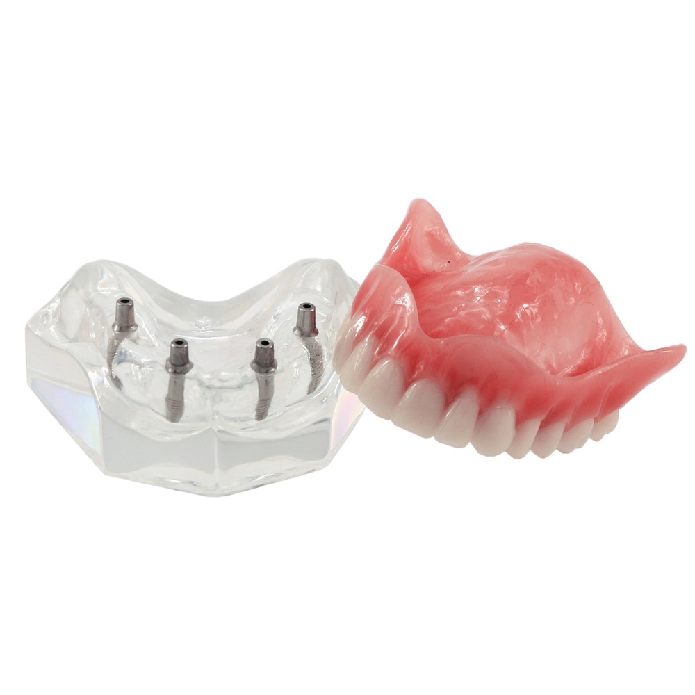 Dental Implant Teeth Model Restoration Overdenture Upper/Lower 4 Implants Demo