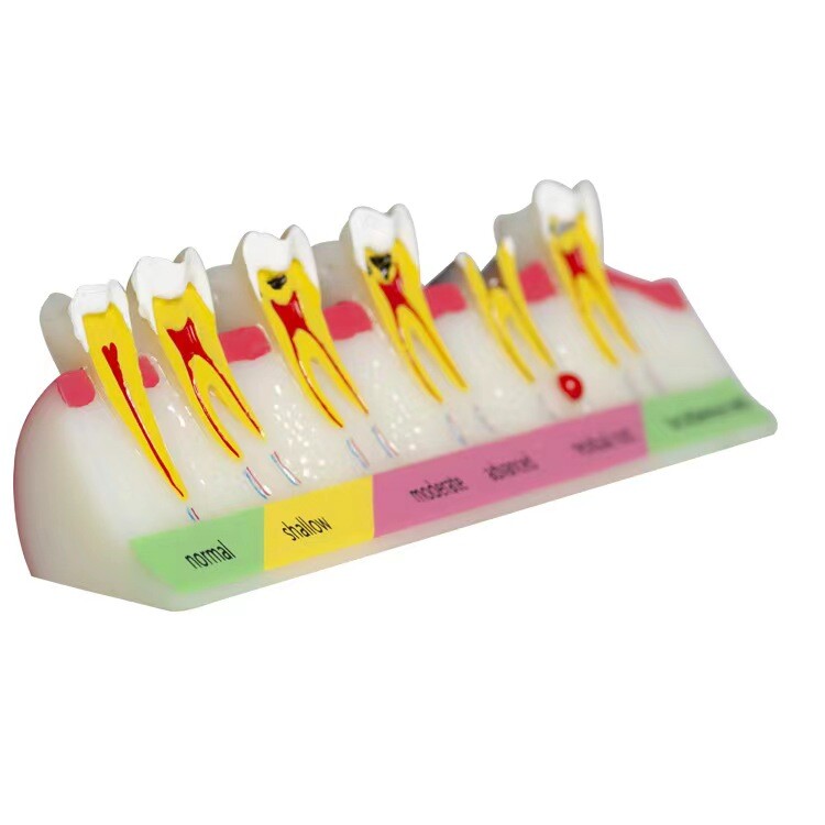 Dental Typodont Teeth Study Teach Tooth Model Implant Endo Caries Demonstration