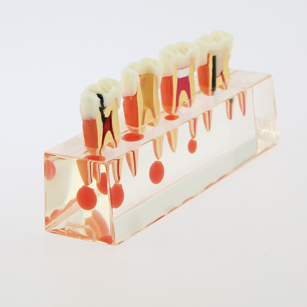 1 Pcs Dental 4 Stage Endodontic Treatment Study Teaching Typodont Teeth Model