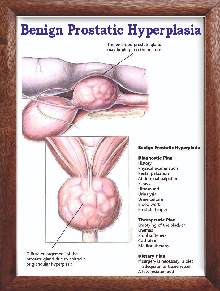 Benign Prostatic Hyperplasia Chart 12x18 inches