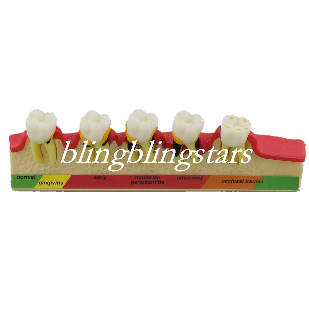 Dental Dentoform Periodontal Disease Assort Teeth Teaching Study Model Typodont