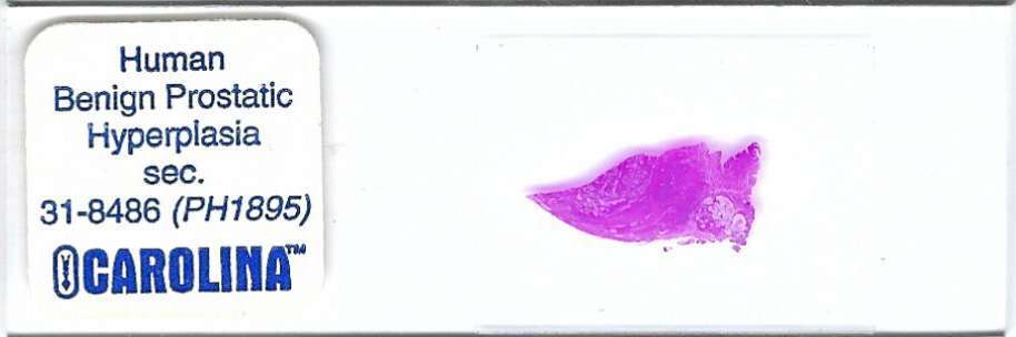 Human Benign Prostatic Hyperplasia Pathology Microscope Slide