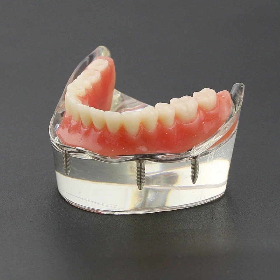 Dental 2/4 Implants Upper Lower Teeth Model Lower Demo Overdenture Restoration