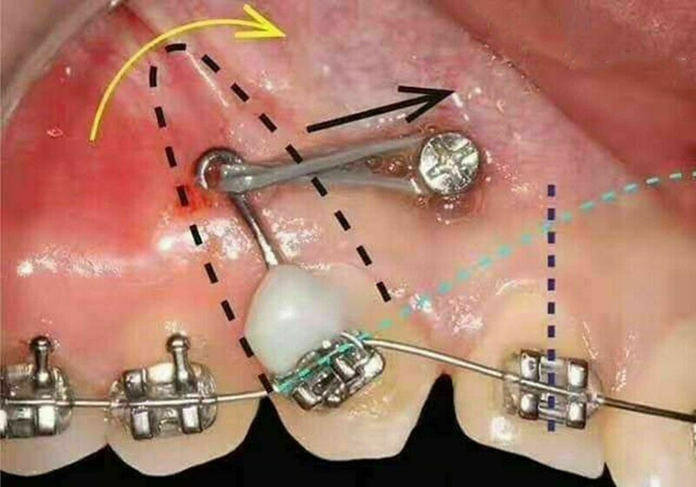 Dental Bonding Crimpable Hook Orthodontic Adhesive Hooks Arch Wire Left+Right