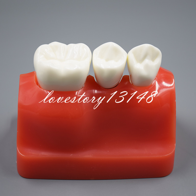 Dental Implant Analysis Crown Bridge Demonstration Teeth Tooth Study Model