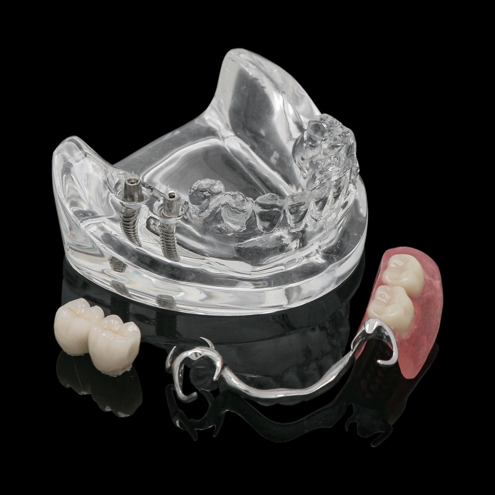 Dental Training Typodont Model with Removable Partial Denture Teaching Model
