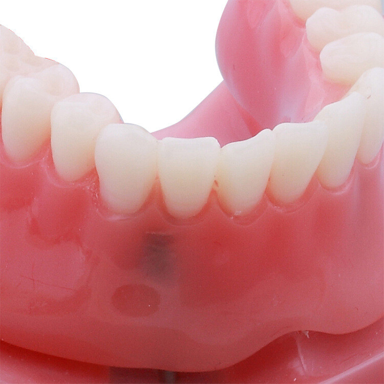 Dental Orthodontic Teaching Models Dental Prosthodontic Model with 2 Implants