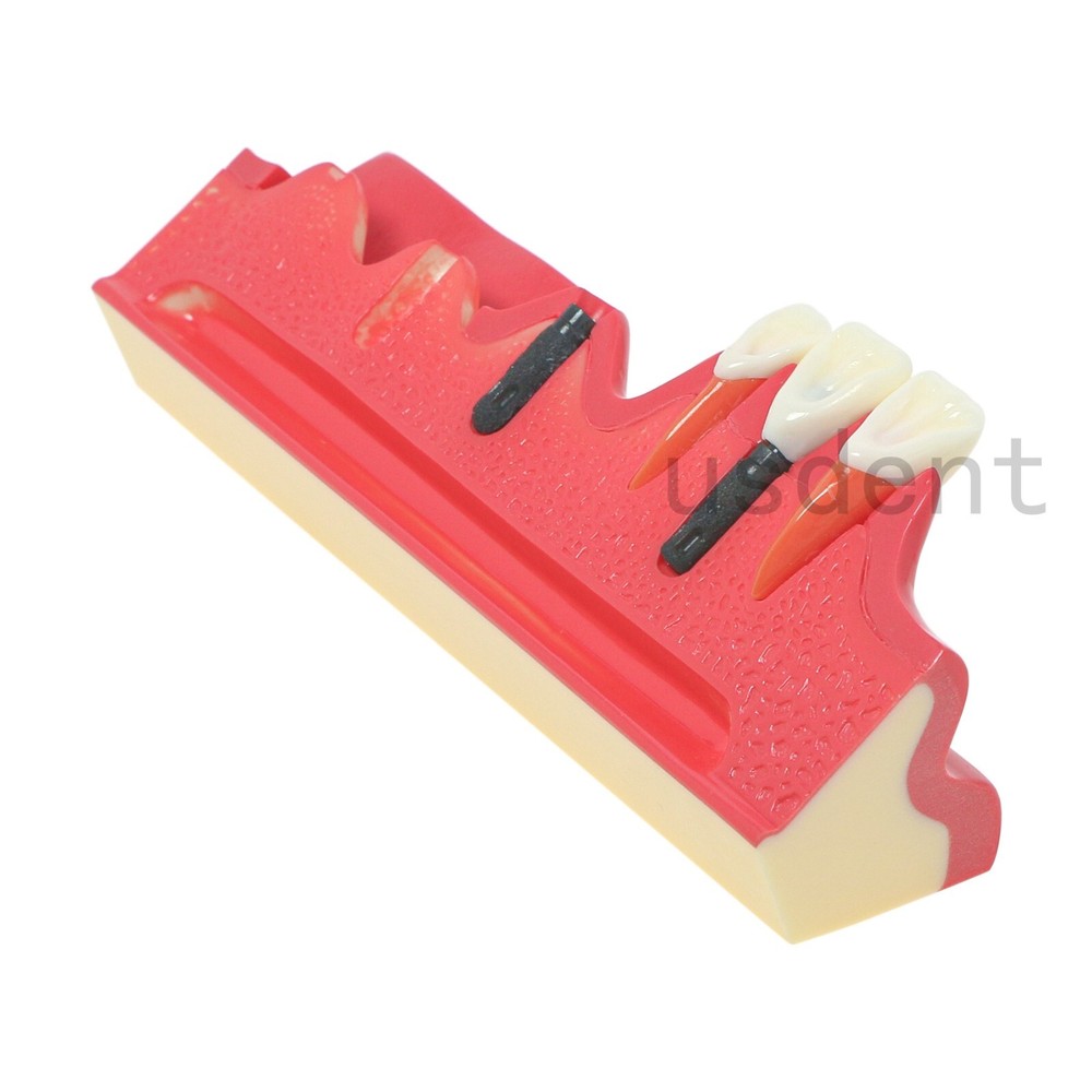 Implant Dental Model Tooth Show the Tooth Implant Process and Progress for Study