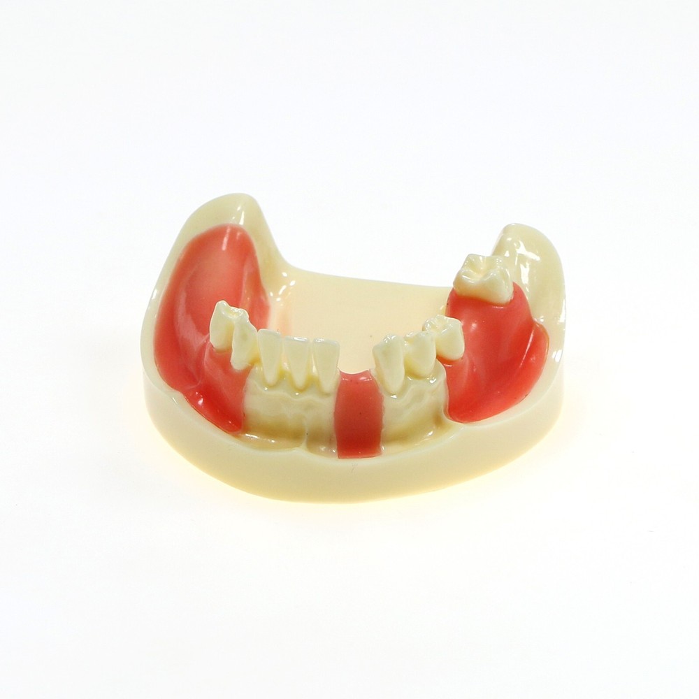 Implant Teeth Model Dental Typodont Ortho Pathological Perio Practice Demo Model
