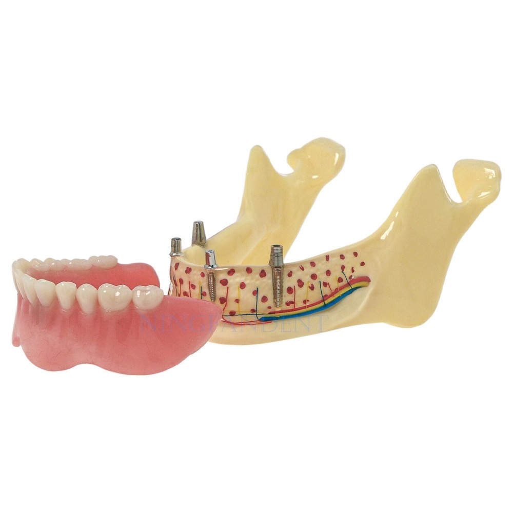 Dental Typodont Implant Restoration Overdenture Model Demo Practice Type Model