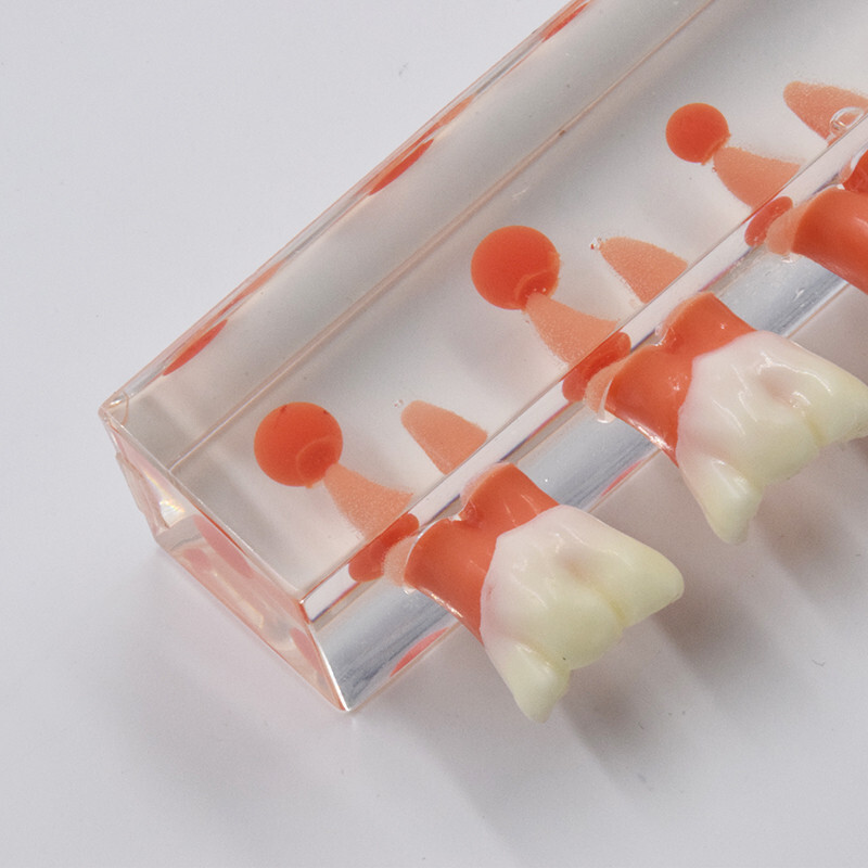 Dental Caries Disease M4018 Study Teaching Model Tooth Correcting Malocclusion