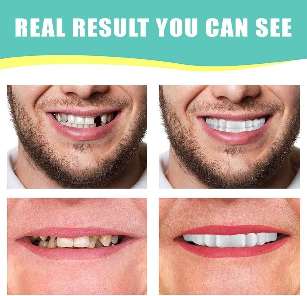 Cosmetic Smile Snap Dentures Kit with Upper & Lower Teeth – Effortless Elegance