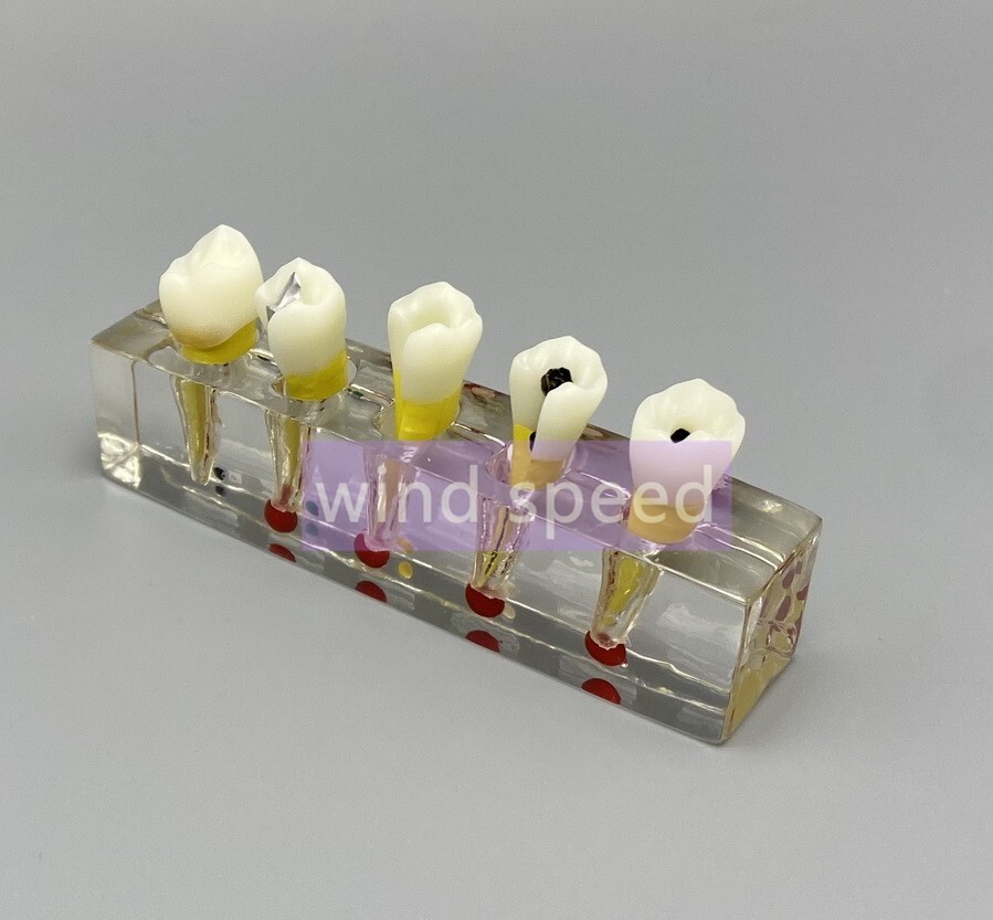 Dental Study Model Pulp Disease root canal curing Clinical Demonstration Analysi