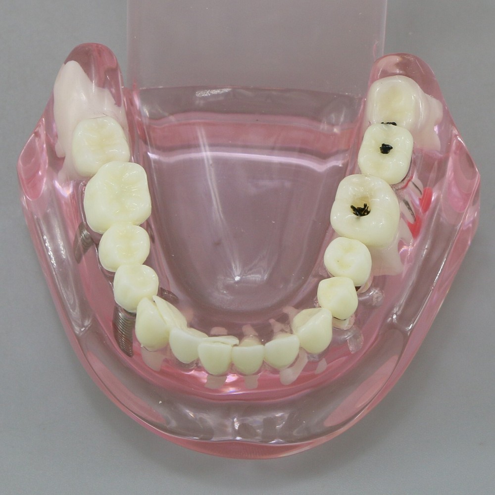 Dental Implant Disease Study Teaching Teeth Model Restoration Bridge Tooth Analy