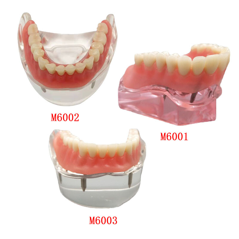 Dental Tooth Model Brushing Training Practice Implant Overdenture Restoration