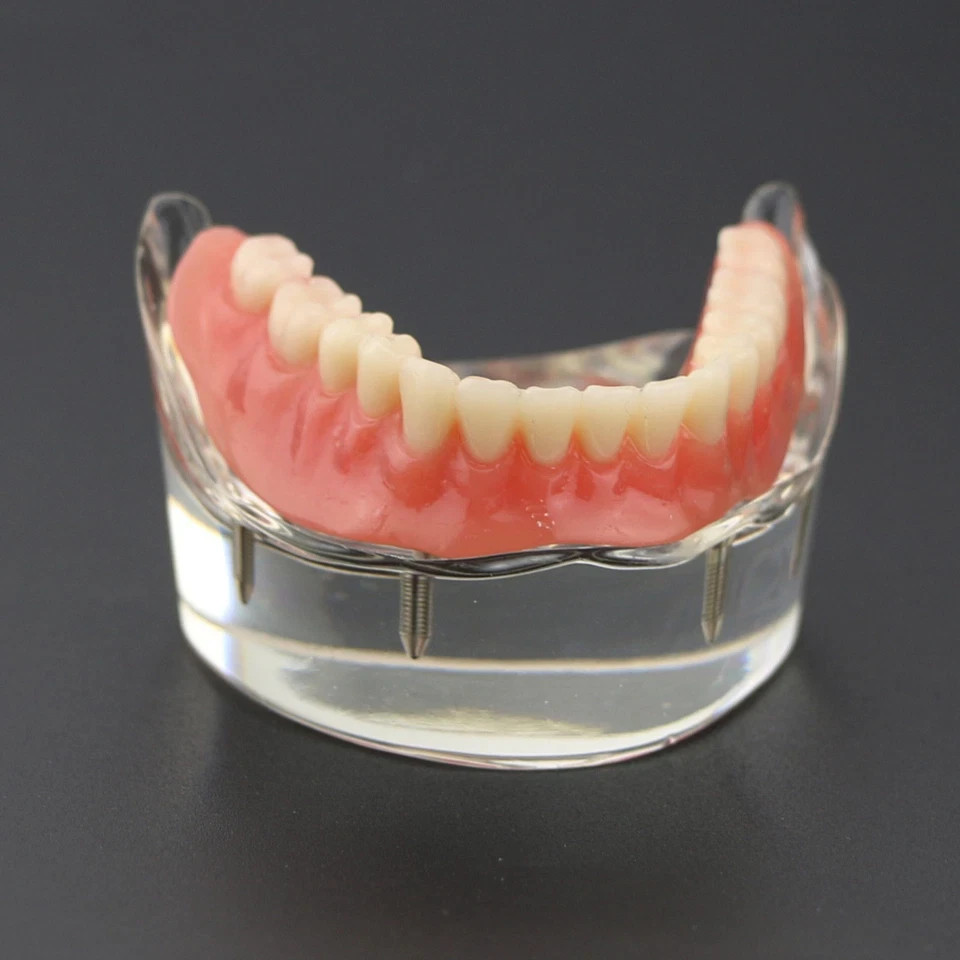 Dental 2/4 Implants Upper Lower Teeth Model Lower Demo Overdenture Restoration